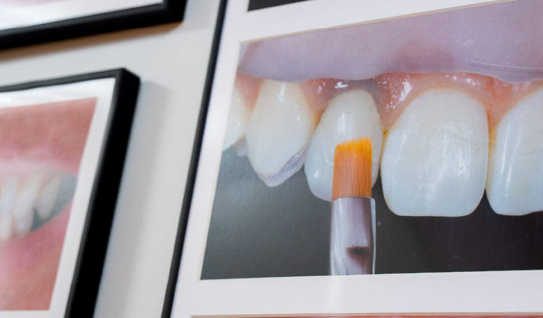 composite bonding in edinburgh